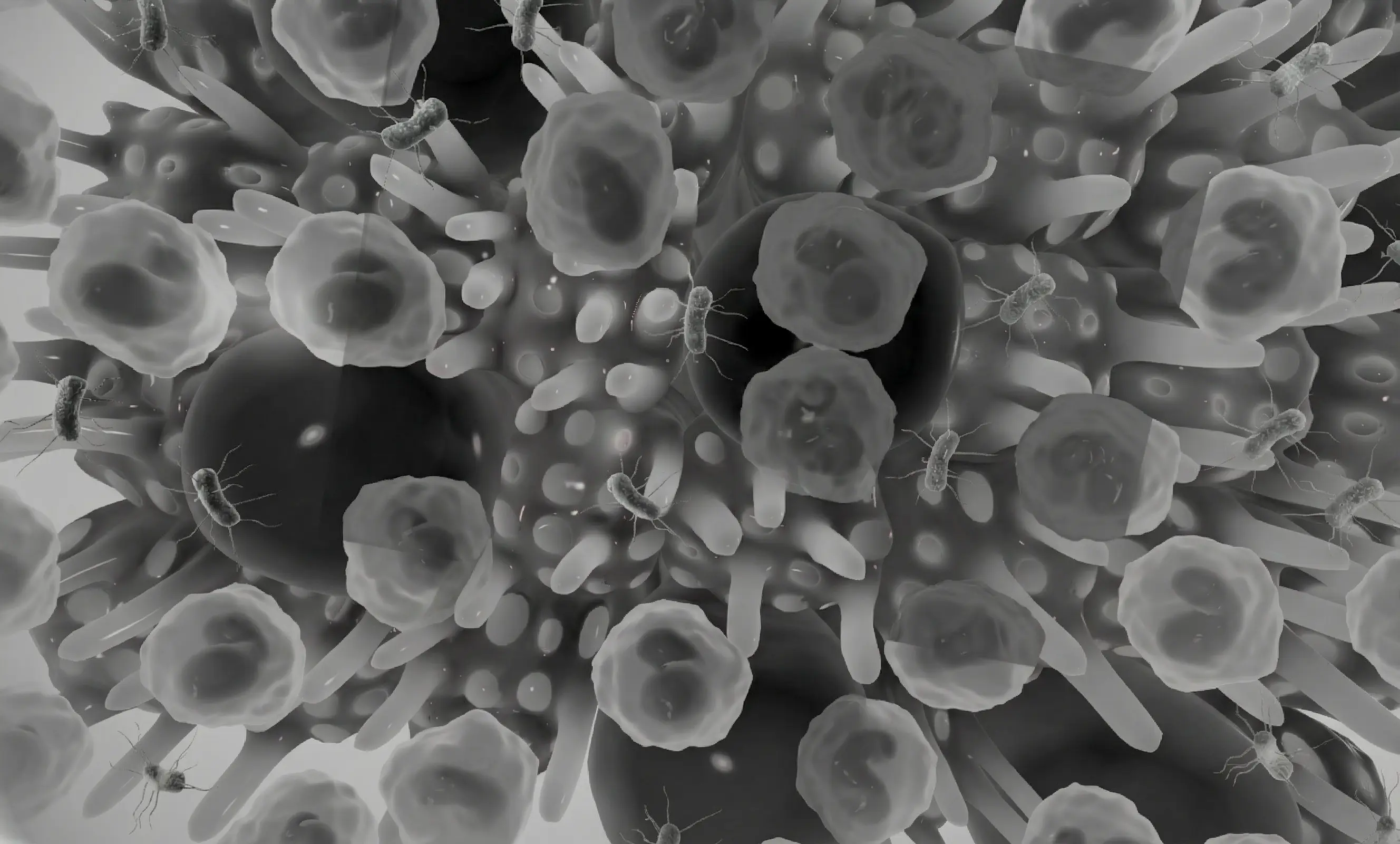 Bronchiectasis